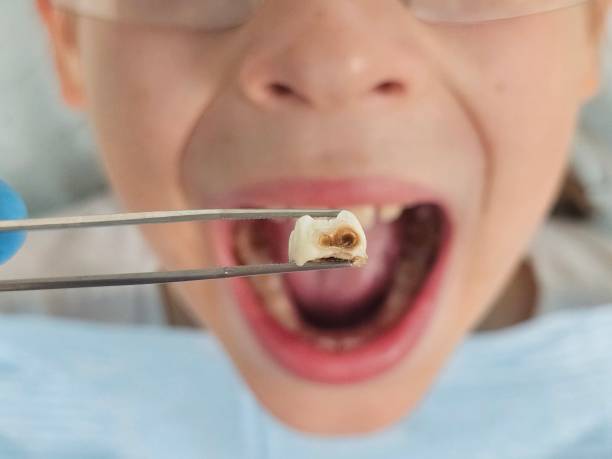 Best Chipped Tooth Repair Near Me  in Danville, AR